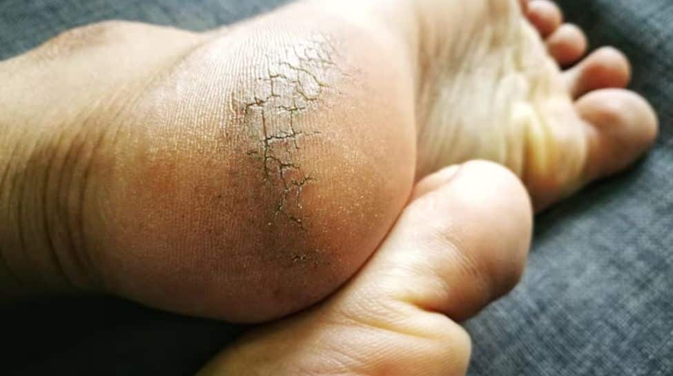 Tired Of Cracked Feet? Try These Effective Home Remedies To Heal Them