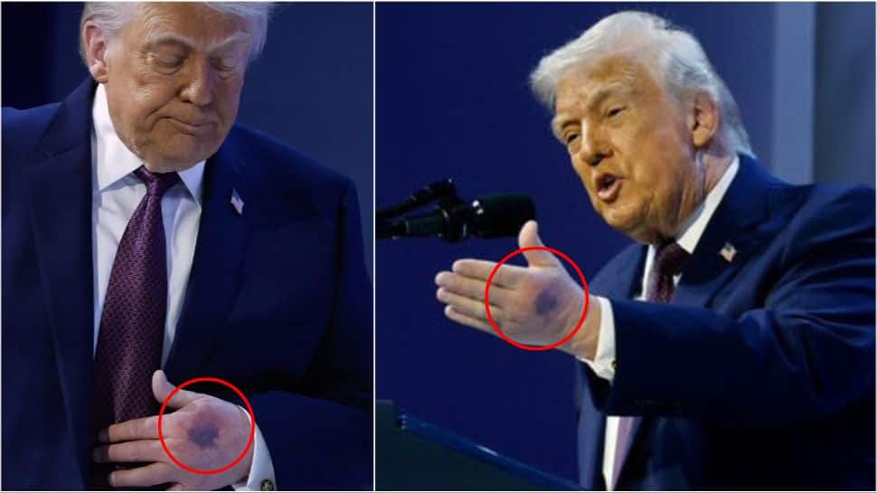 Mystery in Davos: Visible bruising on president Trump's left hand sparks health watch