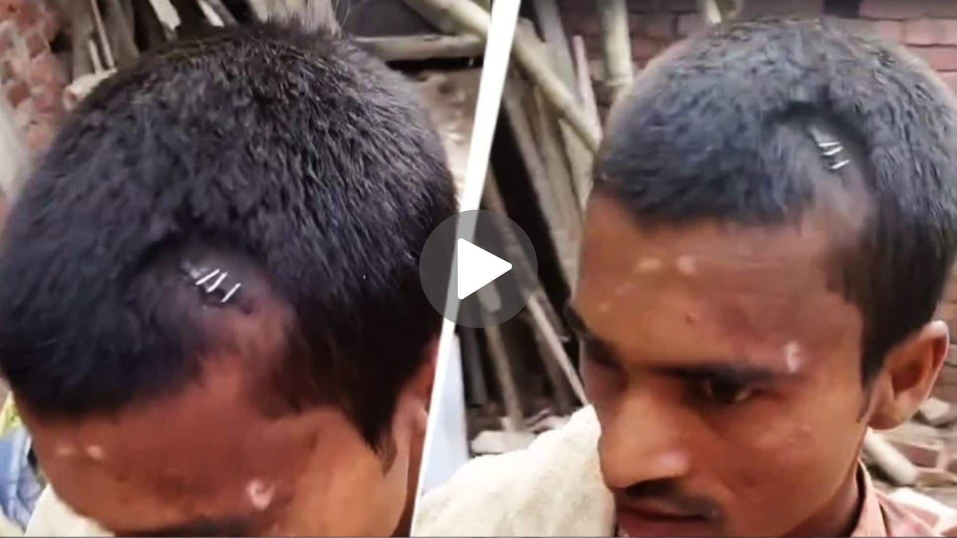 Bihar medical scandal: Horrifying viral video shows quack `stapling` bleeding brain injury with stationery pins | WATCH