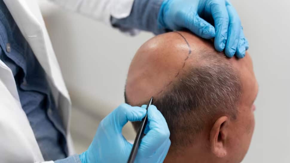 Experts raise concerns over patient safety in aesthetic and hair transplant procedures