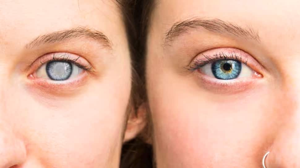 Glaucoma myths vs truth: Eye experts bust common myths about the ‘Silent thief of sight’