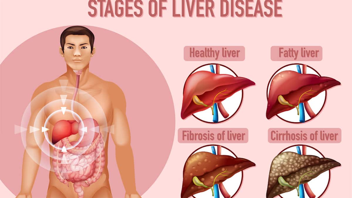 What is non-alcoholic fatty liver disease (NAFLD)? Why nearly 4 in 10 Indians are diagnosed with it
