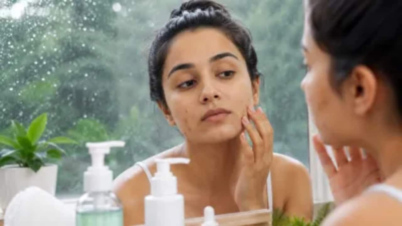 Monsoon affecting your skin? Here are 7 easy ways to treat acne and prevent breakouts
