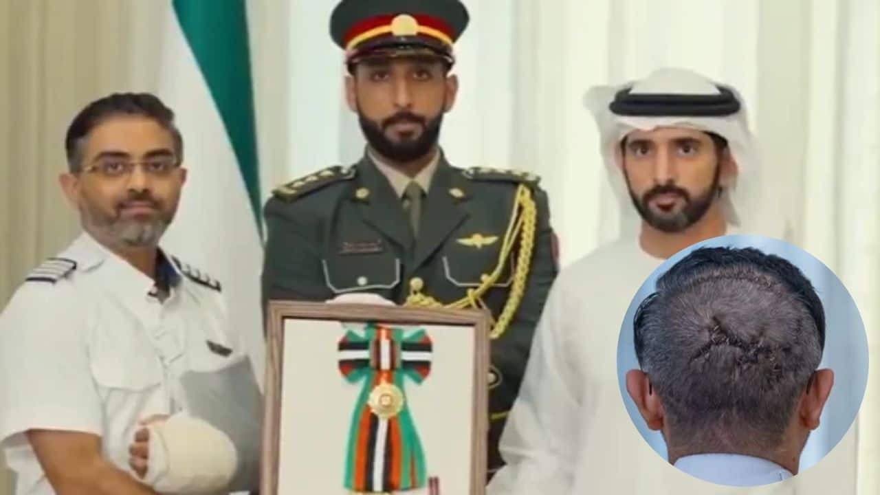 UAE Honors Indian Pilot Who Thwarted Cockpit Attack; Photos Show Head Stitches