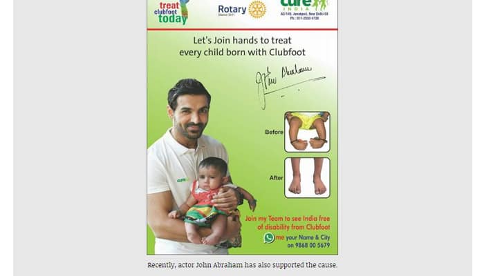 In India 150 Children Are Born With Clubfoot Every Day Guess What It Has A Non Surgical Cure Diseases Conditions News Zee News