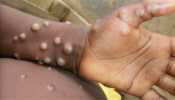 Monkeypox cases to rise globally, warns WHO as disease spreads to 12 countries