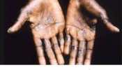Monkeypox leads to death? No medicines so far, but this VACCINE can be a deterrent...