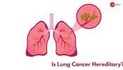 Is lung Cancer Hereditary? Expert Takes on It