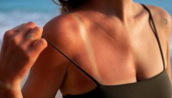 Skin Protection In Summer: Effective Ways To Prevent Sunburn And Heat Rash
