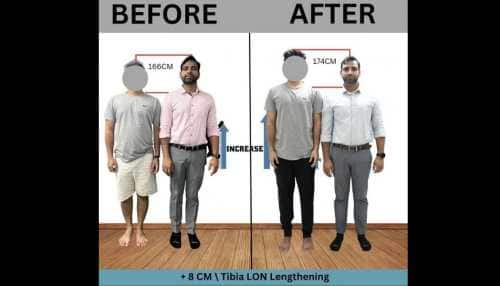 Limb Lengthening made easy Height Increase Info provides an