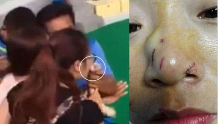 Woman brutally bitten on nose after she tries to kiss a python - Watch this viral video