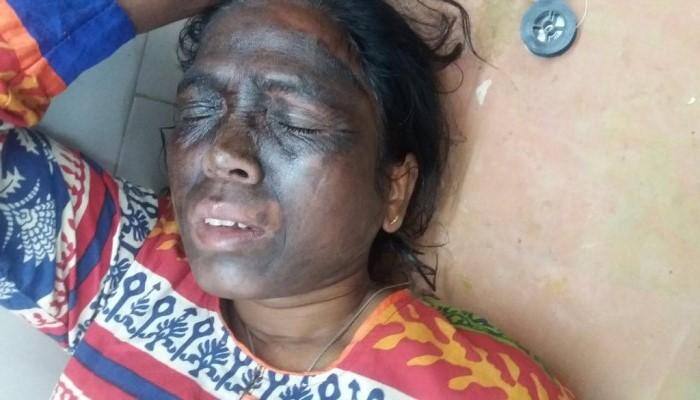 Chhattisgarh AAP leader Soni Sori attacked with acid, hospitalised