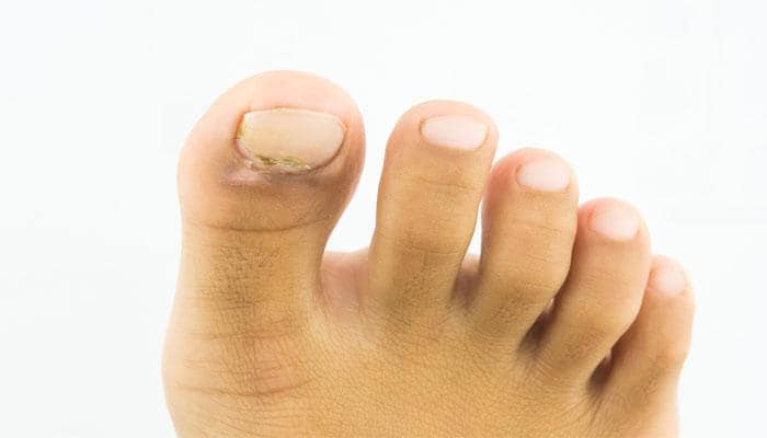 Risk factors for toenail fungal infection