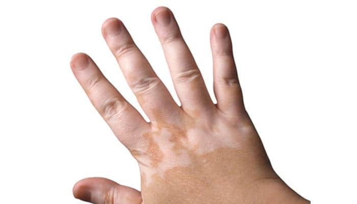 Try these simple home remedies to treat white spots or patches on skin!