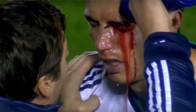 BLOODIED: When one-eyed Cristiano Ronaldo scored for Real Madrid – WATCH