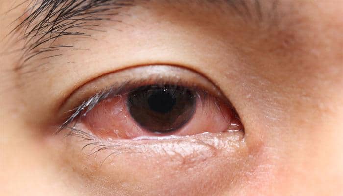 Download Know The Common Causes Of Red Or Bloodshot Eyes Health News Zee News