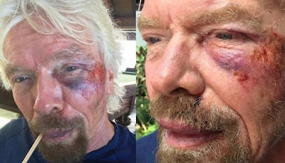 This is how billionaire Richard Branson looks after cheating death in a violent high-speed bike crash