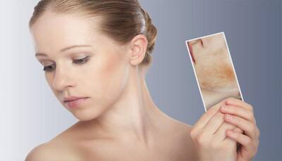 Suffering from eczema? Try these natural remedies to treat the skin condition!