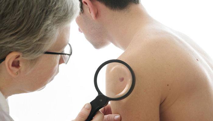 This new test can diagnose skin cancer much more quickly!