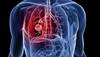 lung cancer cells
