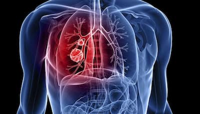 Individuals with sleep apnea may face worsened lung cancer