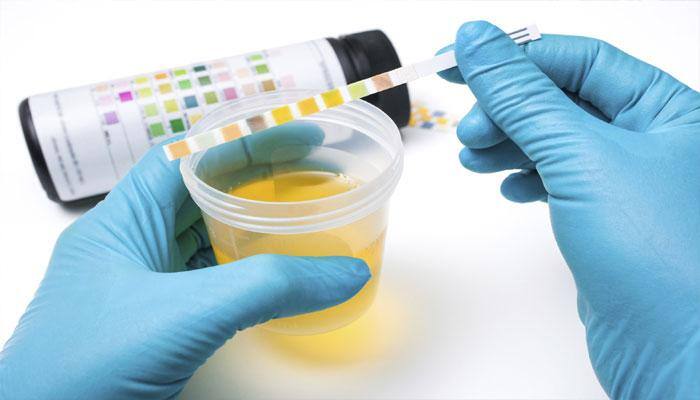 Newly developed urine test could predict high-risk cervical cancer