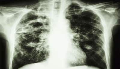 Ancient Chinese medicine can help fight TB: Study