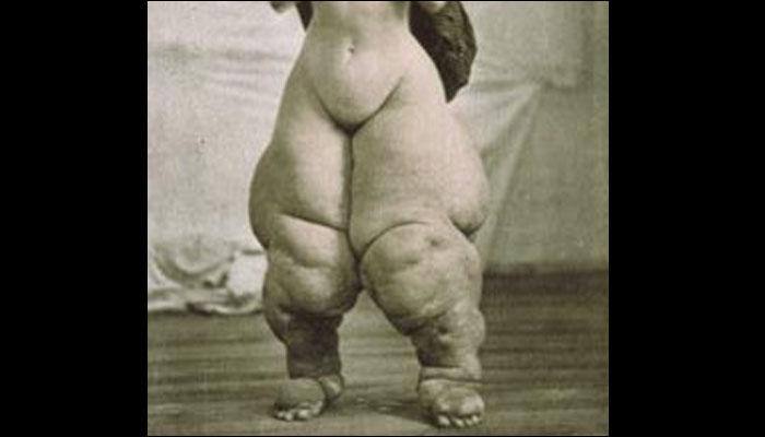 New treatment could fast-track elephantiasis elimination