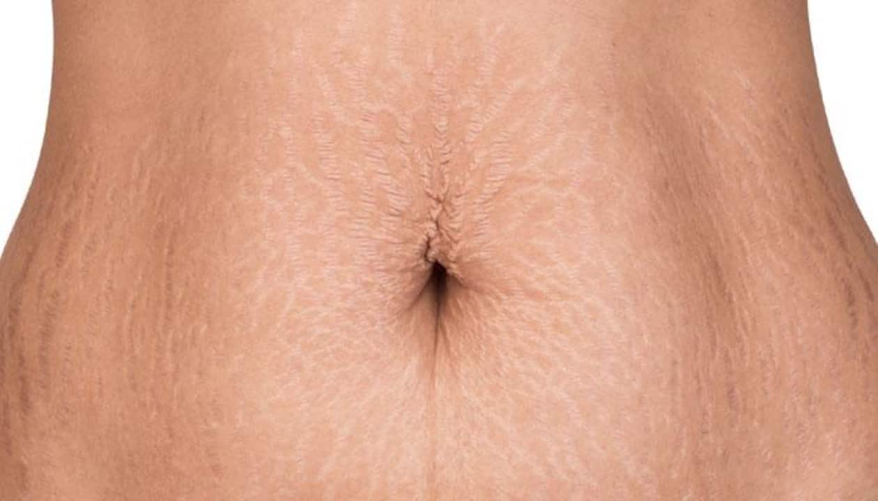 Can Vicks Vaporub Really Get Rid Of Stretch Marks?