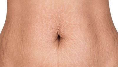 Try these simple home remedies to get rid of stretch marks!