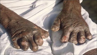 Leprosy: Symptoms, diagnosis and key facts