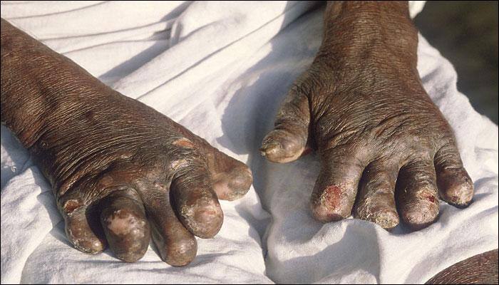 Leprosy: Symptoms, diagnosis and key facts
