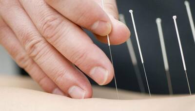 Acupuncture treatment help reduce chronic pain, depression: Study