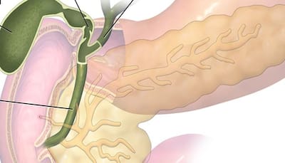 Genetic variants that may predispose individuals to develop gallbladder cancer identified