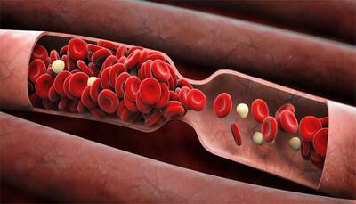 These signs reveal you might have a blood clot!