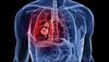 India signs WHO's 'call for action', pledging to end TB in South East Asian region by 2030