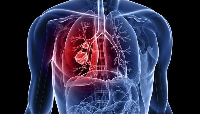 India signs WHO's 'call for action', pledging to end TB in South East Asian region by 2030