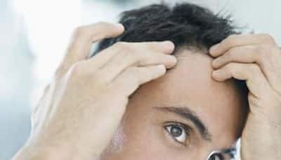 Hair transplant surgery: The perfect solution for your baldness