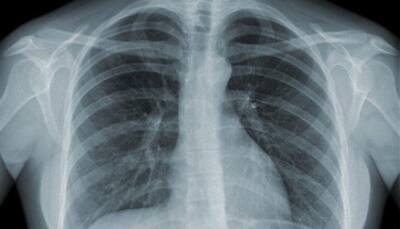 China reports 900,000 new TB cases every year