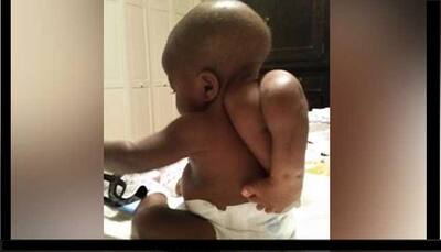 Doctors remove rare parasitic twin from 10-month-old girl's back