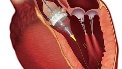 Too sick for heart valve surgery? Conscious sedation, a safe alternative to general anesthesia