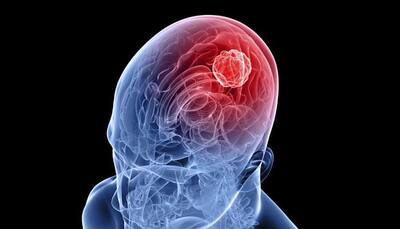 Combination therapy may increase survival rates in brain cancer patients