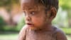 This 2-year-old Indian girl suffers from rare skin condition causing her to develop lizard-like scales