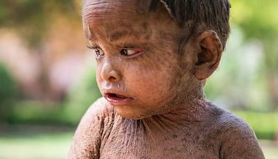 This 2-year-old Indian girl suffers from rare skin condition causing her to develop lizard-like scales