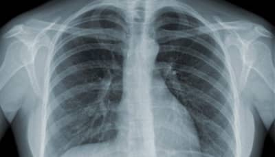 India's tuberculosis challenge: Drug-resistant TB could make up 1 in 10 cases of disease by 2040