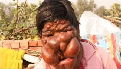 Teen boy from Bihar nicknamed 'Ghost Boy' – Find out why!