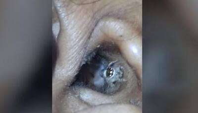 TERRIFYING moment when a spider crawled out of Karnataka woman’s ear at hospital - Watch