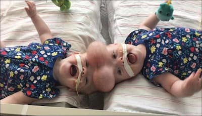 Suffering from rare condition, conjoined twins get a new lease of life after 11-hour surgery!