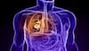 Lung cancer: Thousands of Australians to undergo regular chest scans for early detection