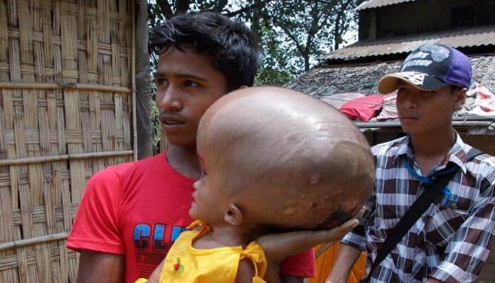 Tripura&#039;s &#039;giant head’ baby girl dies before corrective surgery